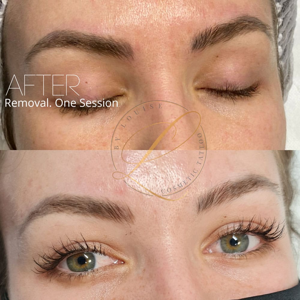 Microblading Laser Removal Can Microblading be Removed  Removery