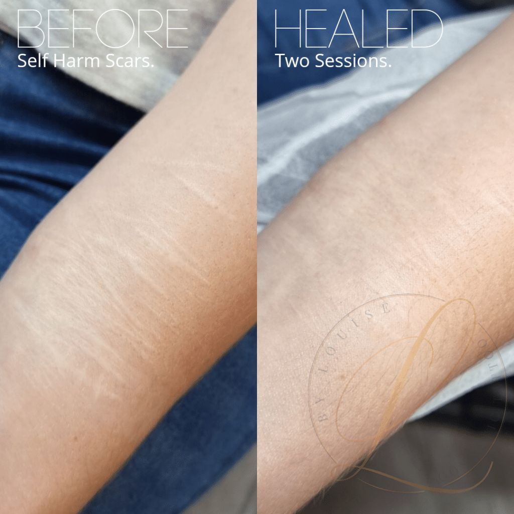 SCAR AND STRETCH MARK COVER UP